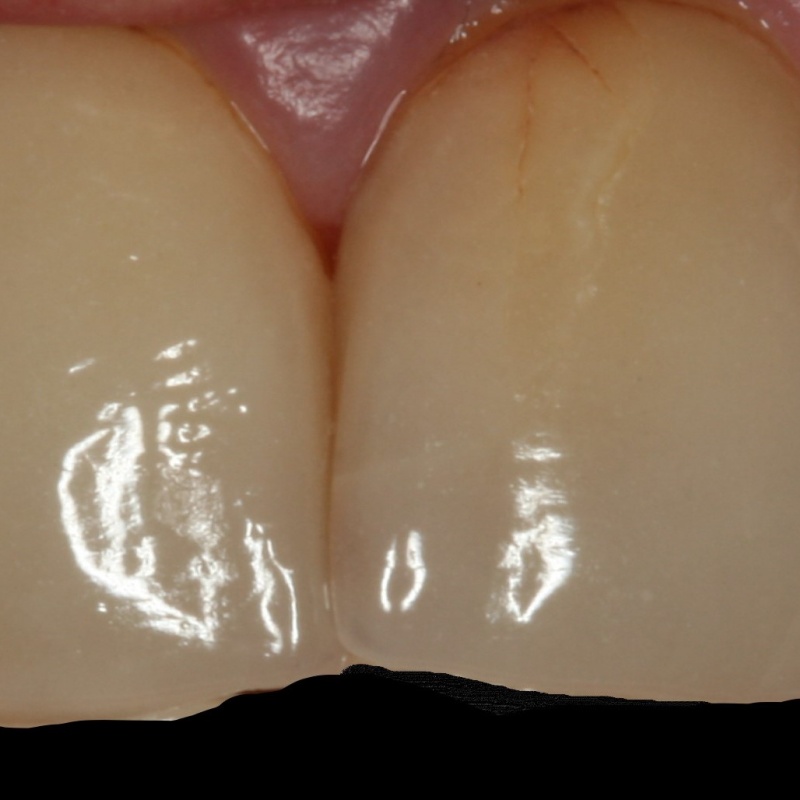 Veneers before