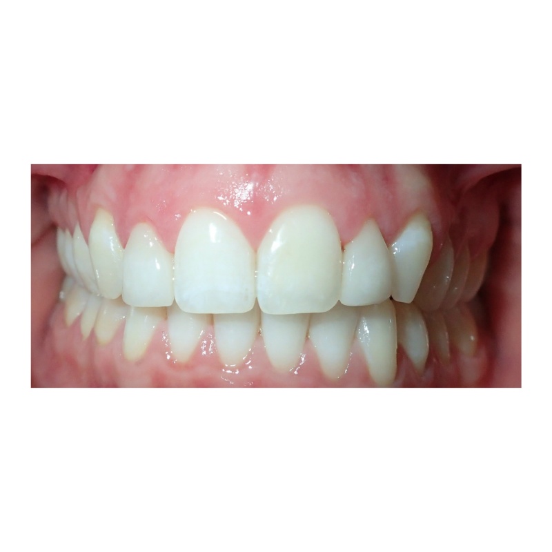 Invisalign and Veneers after