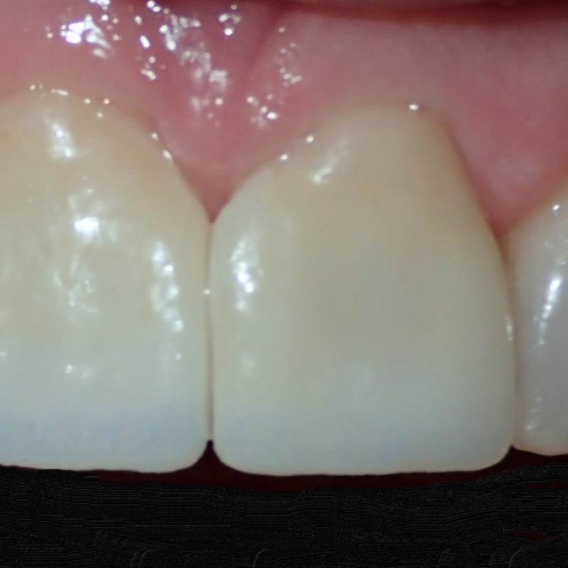 Veneers after