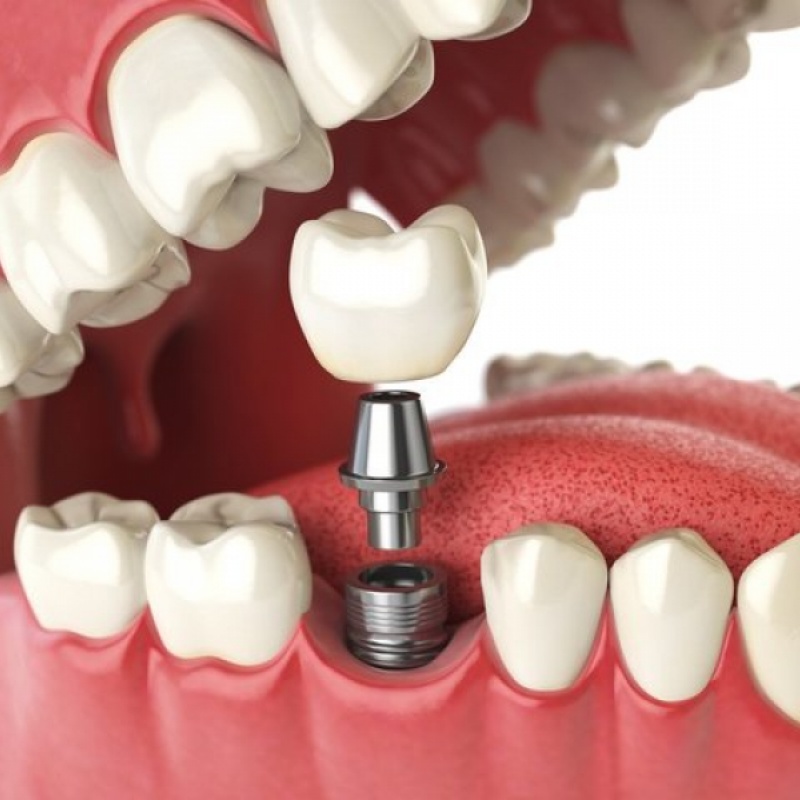 Dental implants