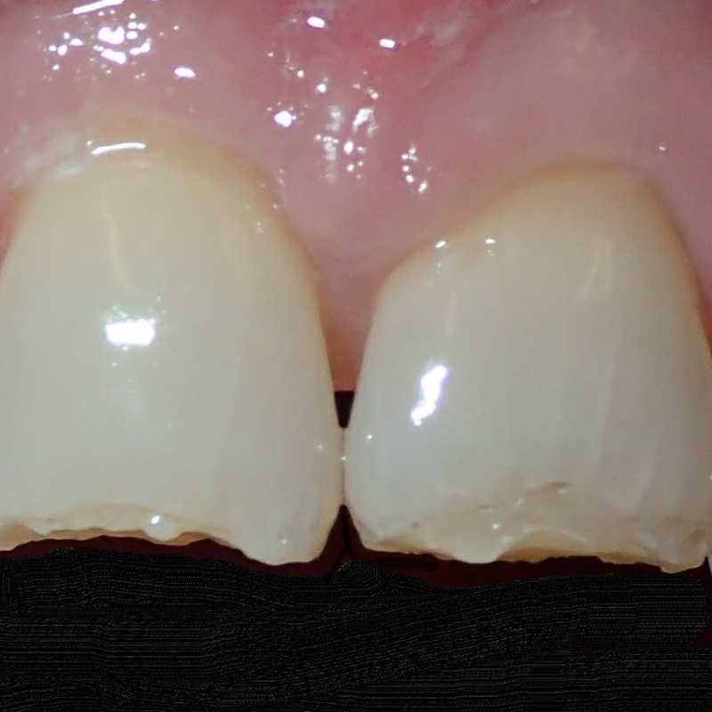 Veneers before