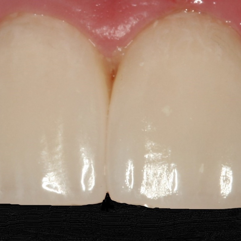 Veneers after