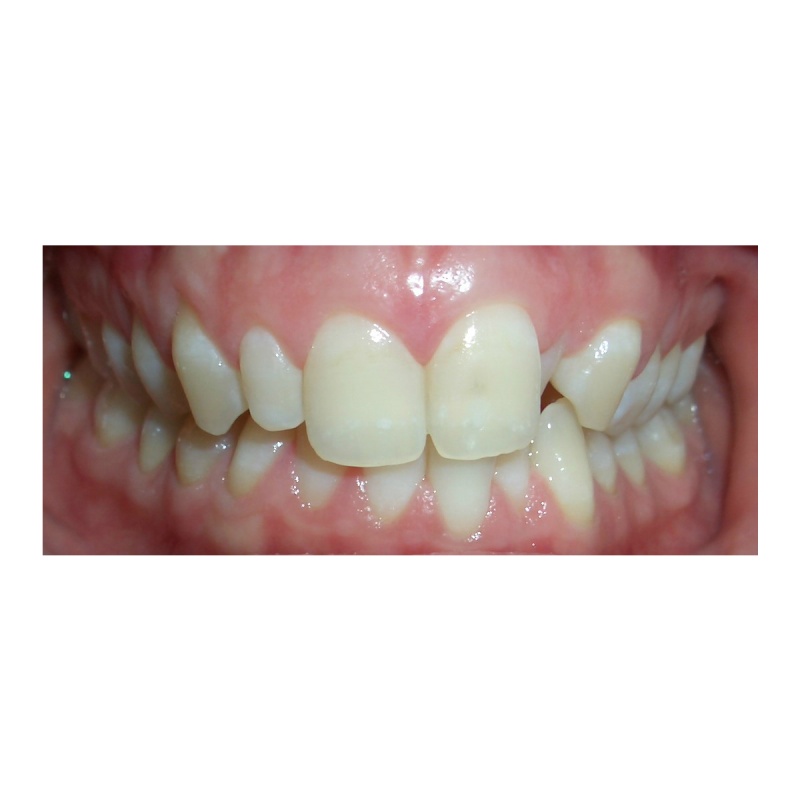 Invisalign and Veneers before