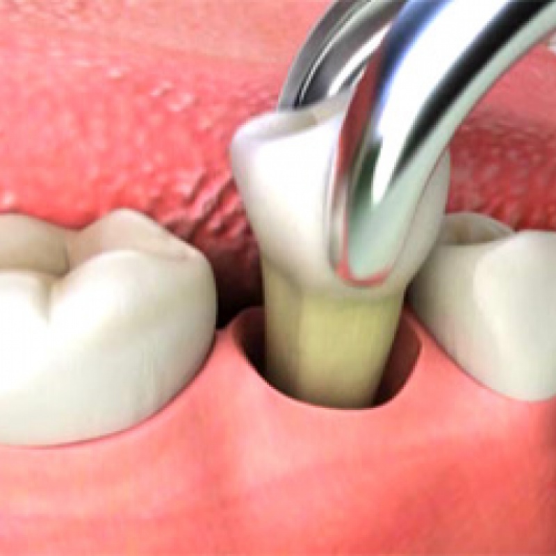 Extractions
