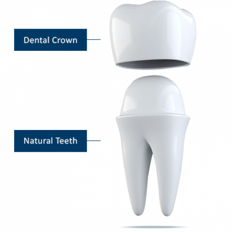 Dental implants